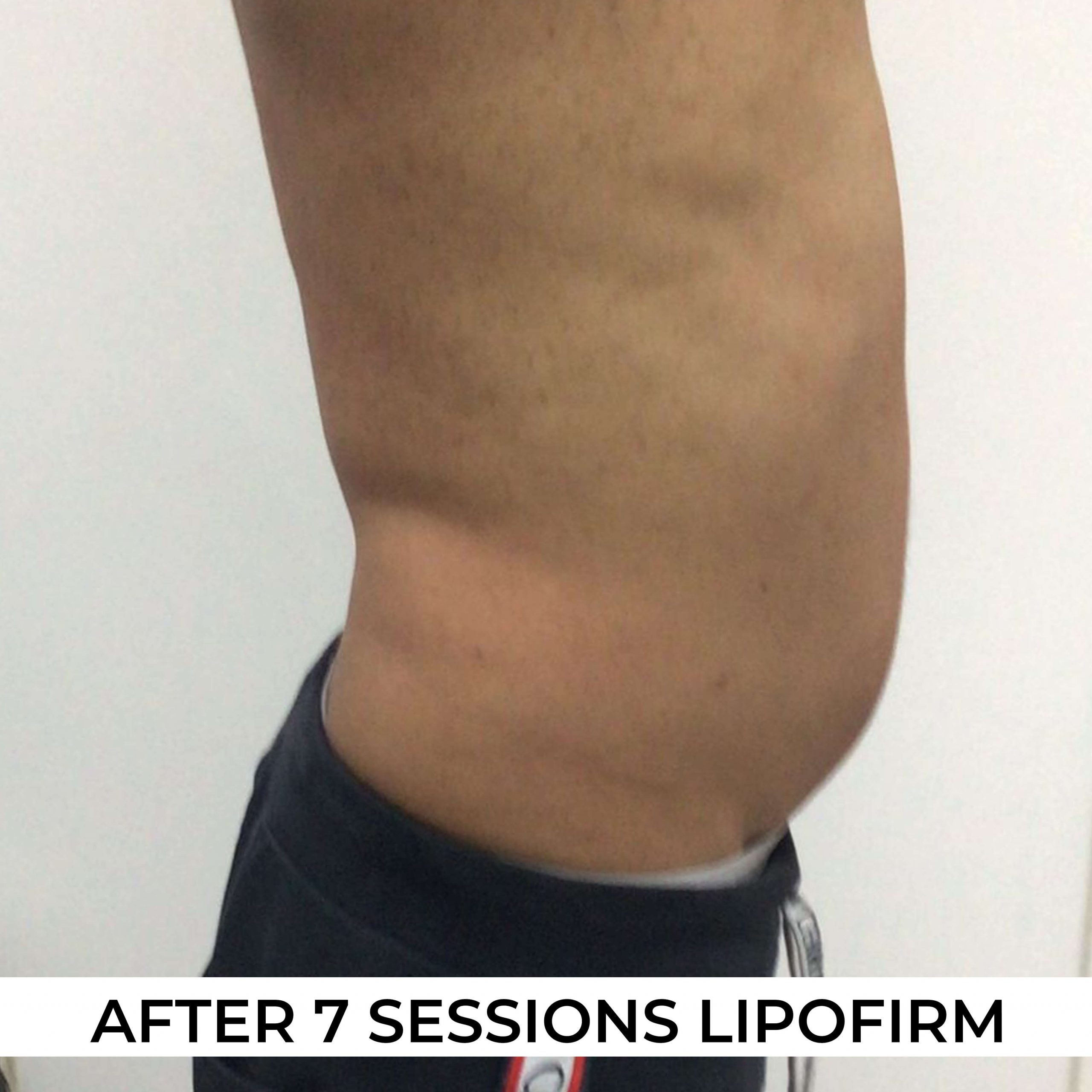 after image of Lipofirm procedure