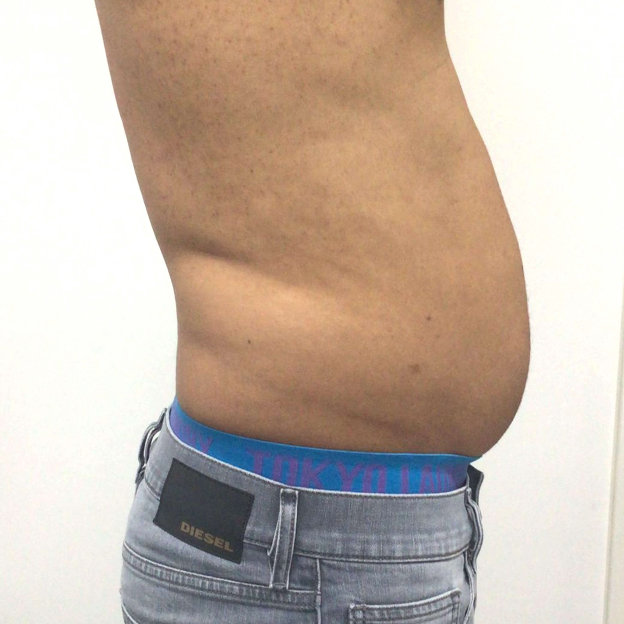 before image of Lipofirm procedure