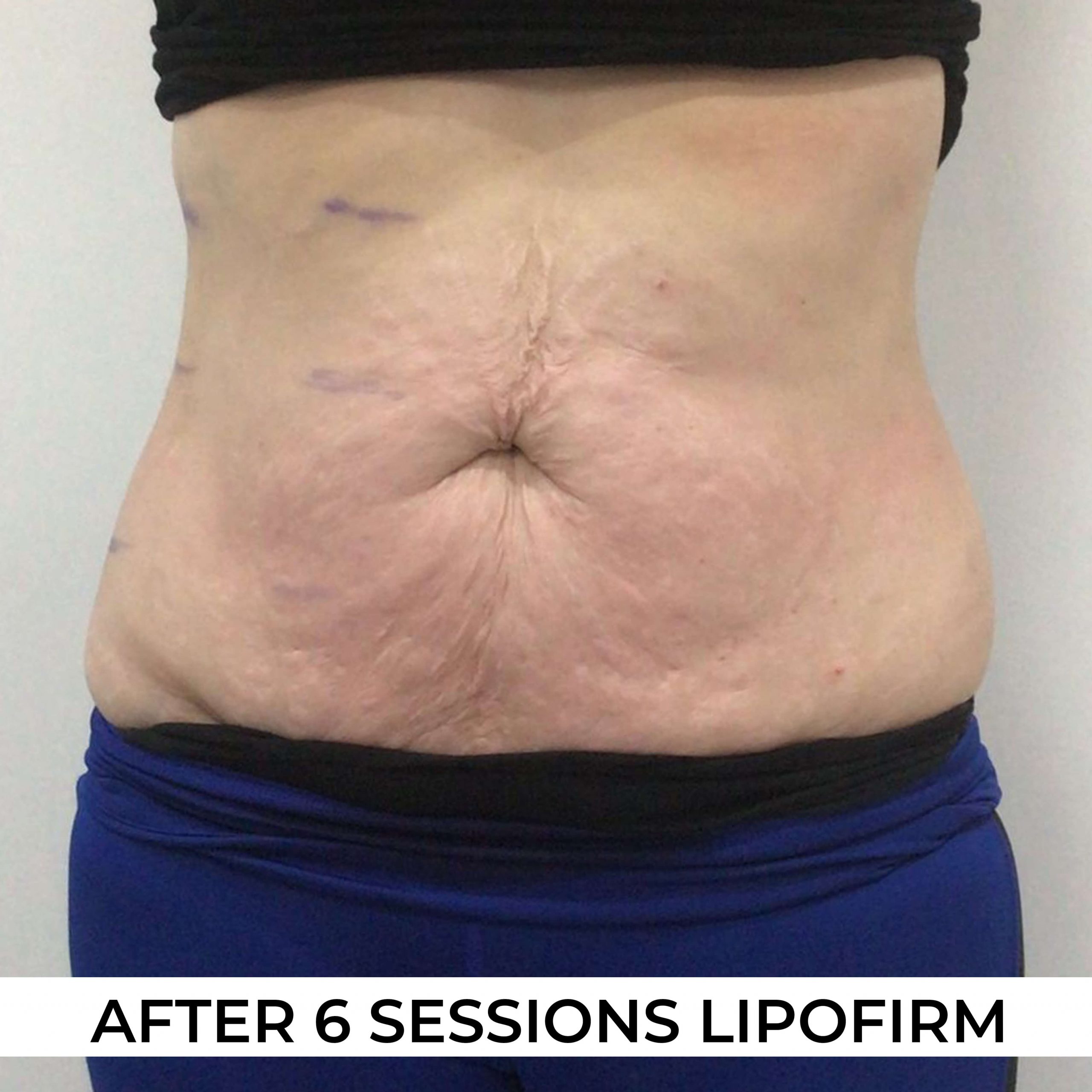 after image of Lipofirm procedure