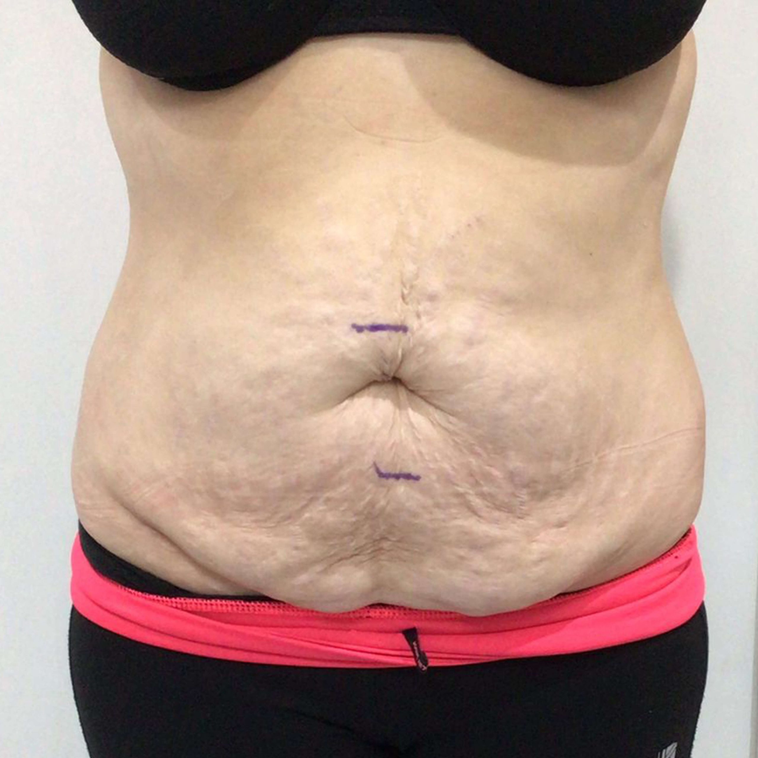 before image of Lipofirm procedure