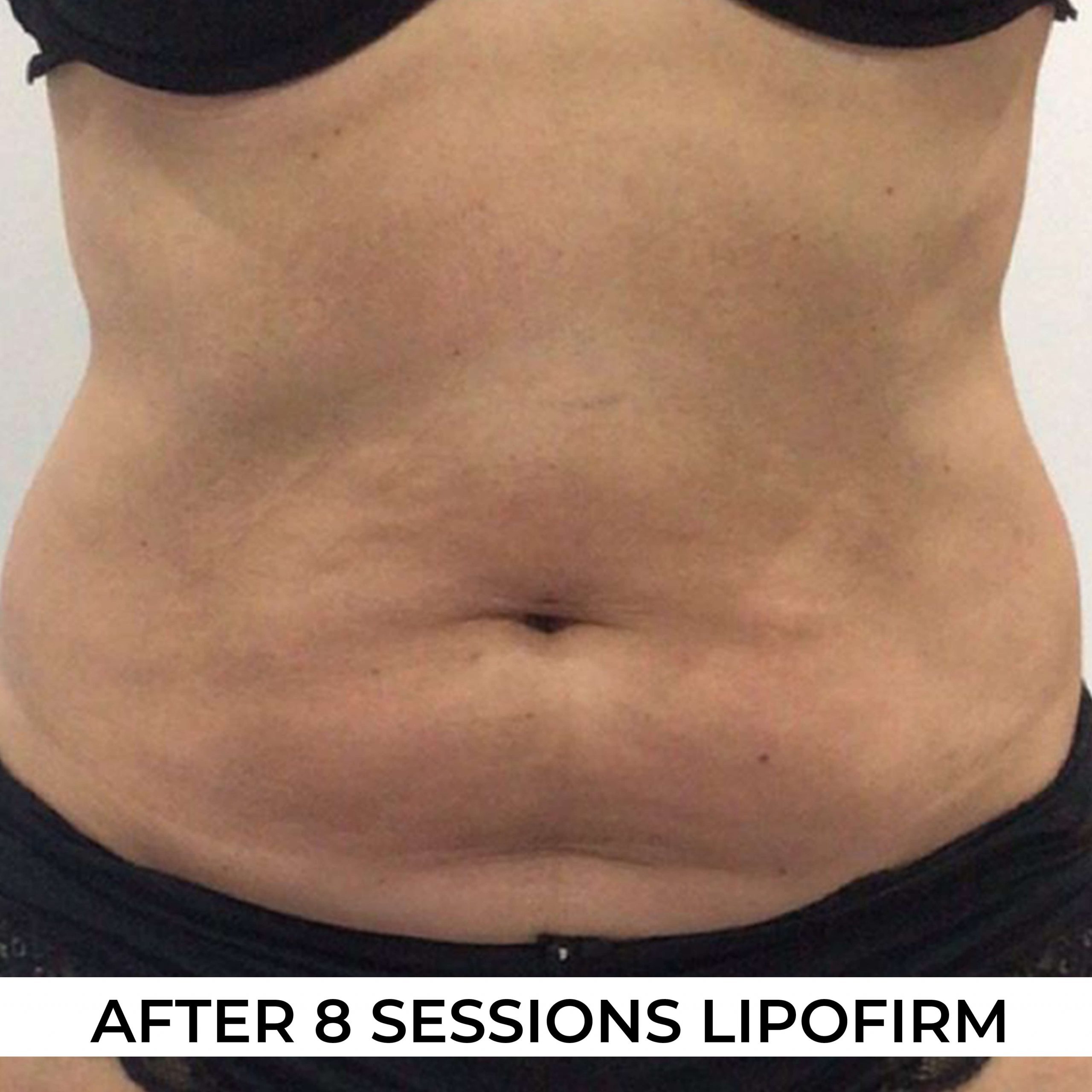after image of Lipofirm procedure