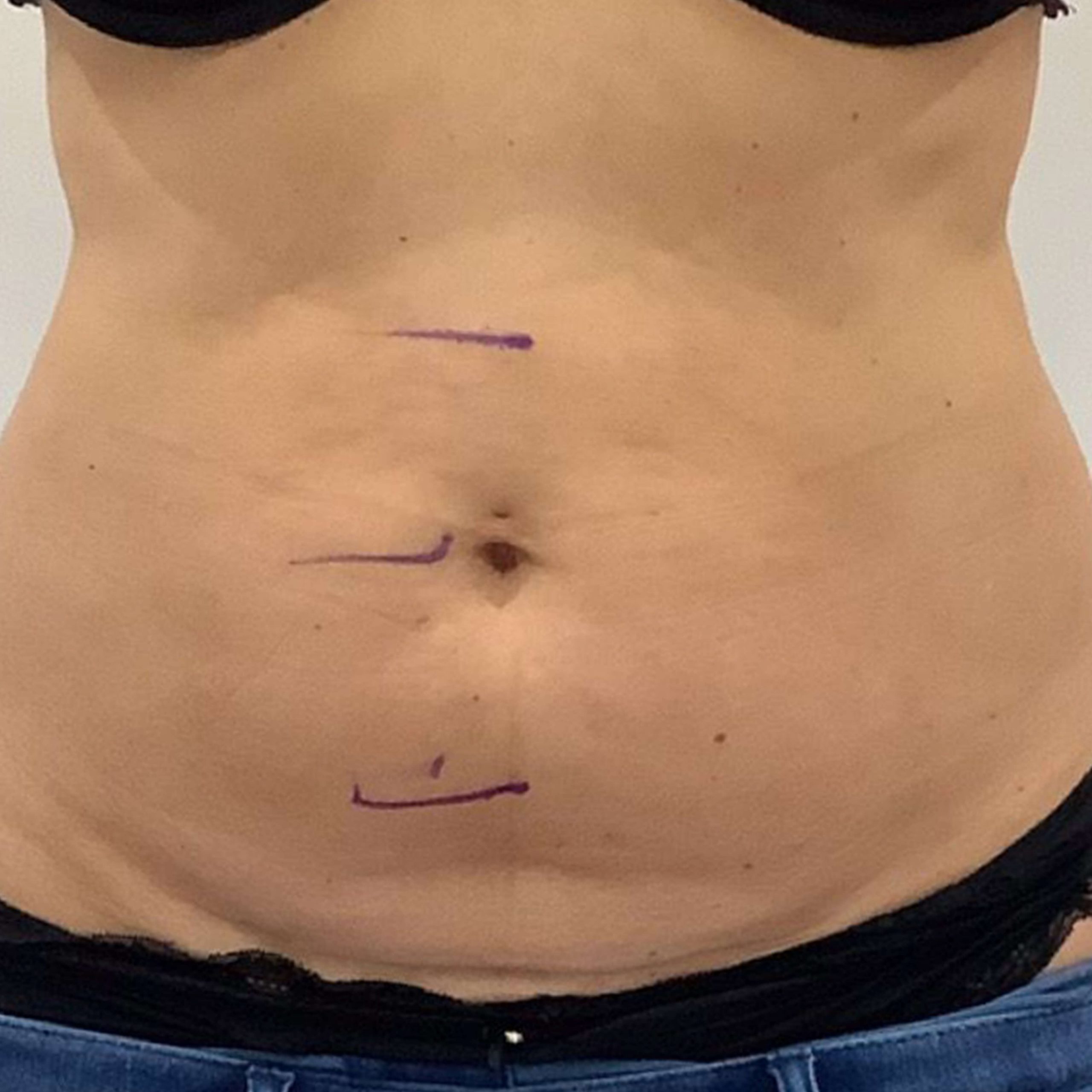 before image of Lipofirm procedure