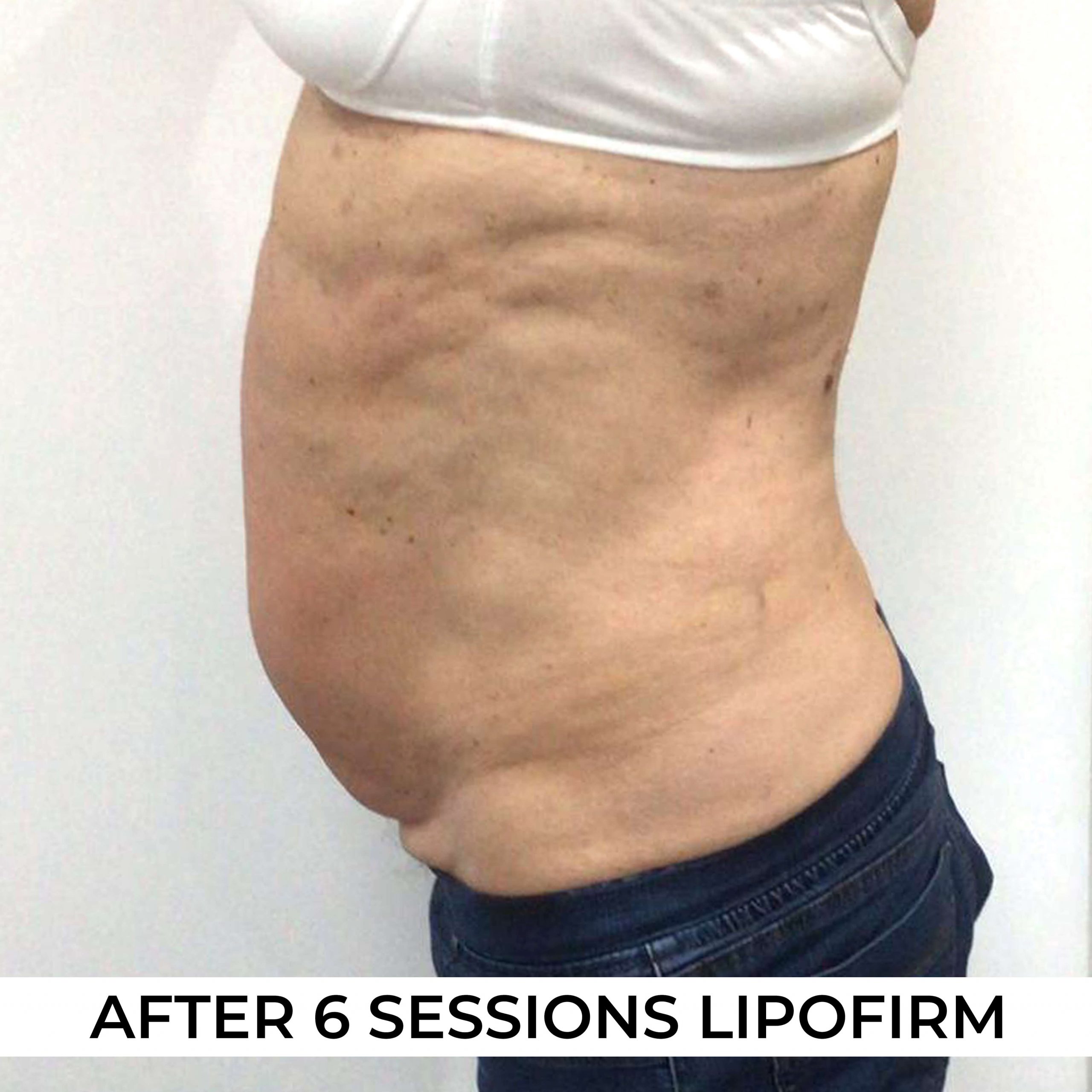 after image of Lipofirm procedure