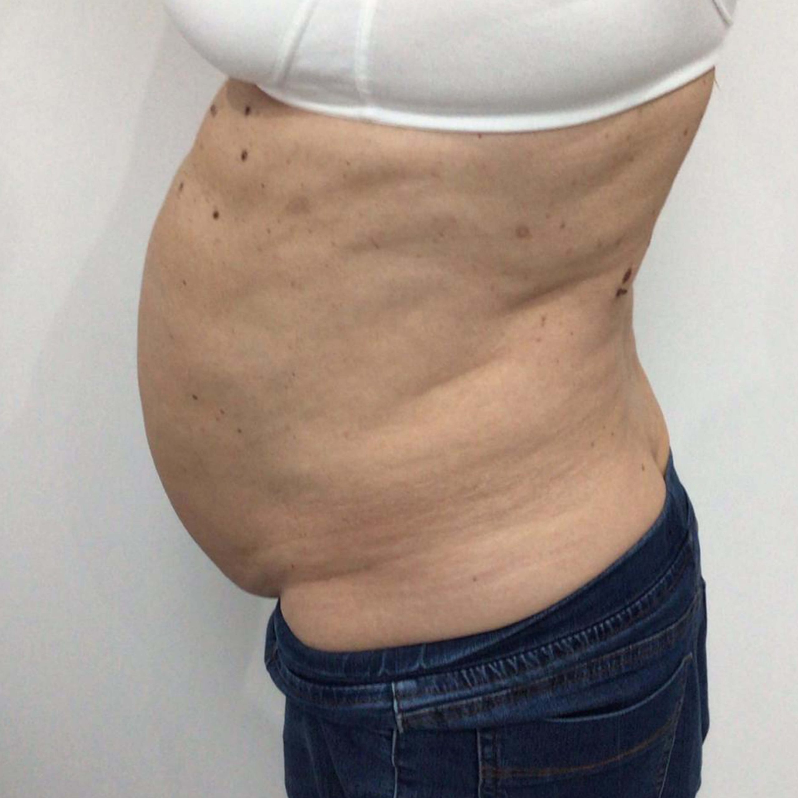 before image of Lipofirm procedure
