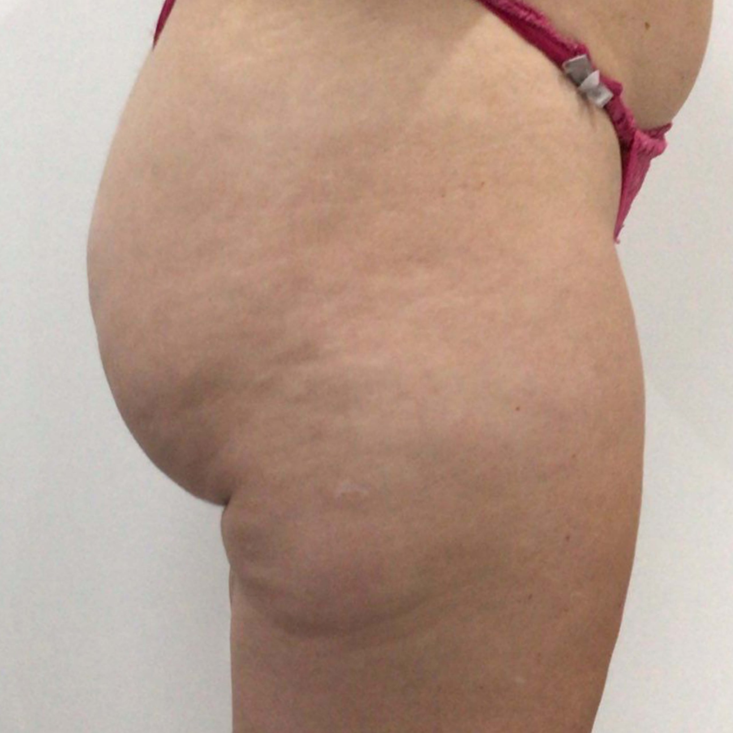 before image of Lipofirm procedure