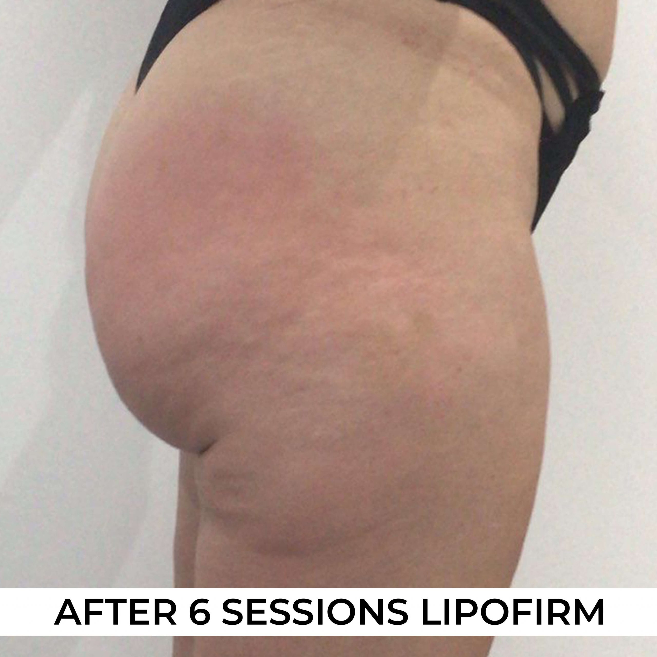 after image of Lipofirm procedure