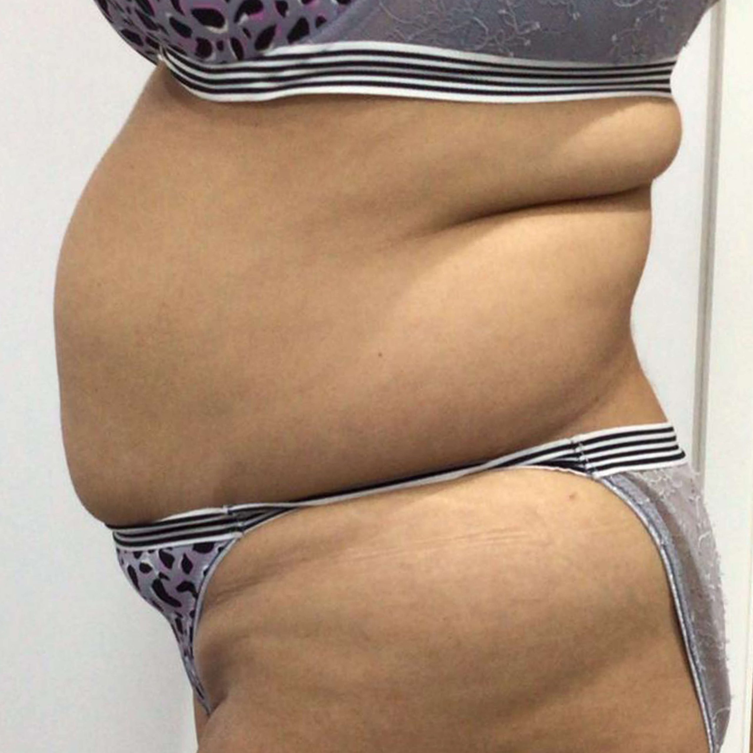before image of Lipofirm procedure