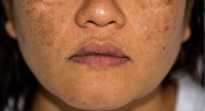 Young Asian women having a skin problem with melasma and hyperpigmentation on her face.both side on her cheeks.