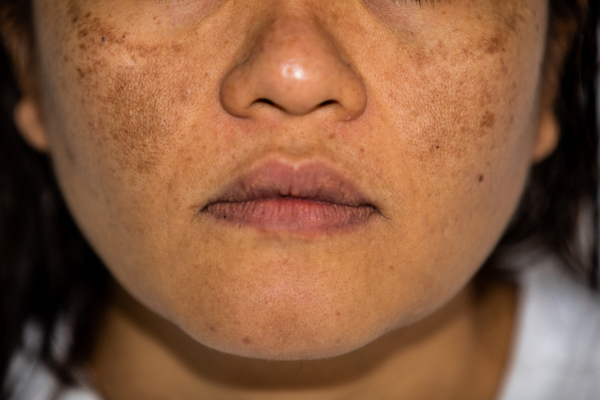 Young Asian women having a skin problem with melasma and hyperpigmentation on her face.both side on her cheeks.