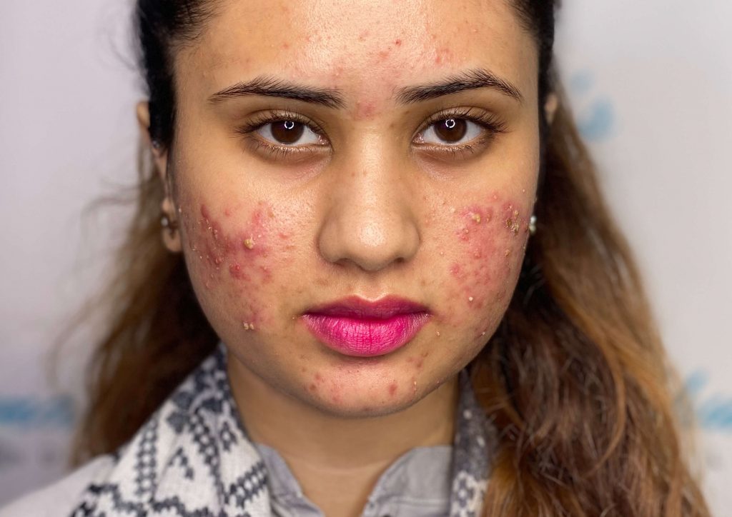 acne treatment in london