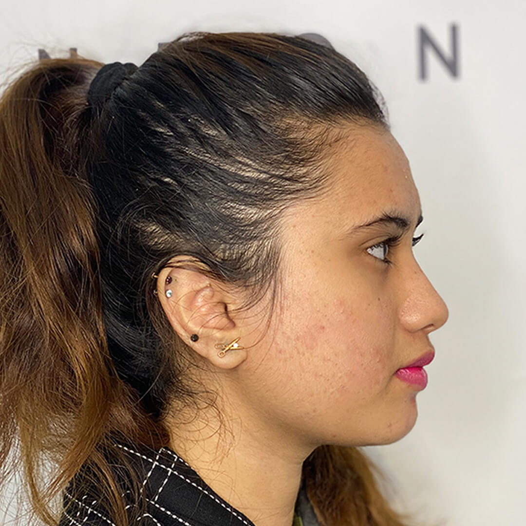 After acne treatment london