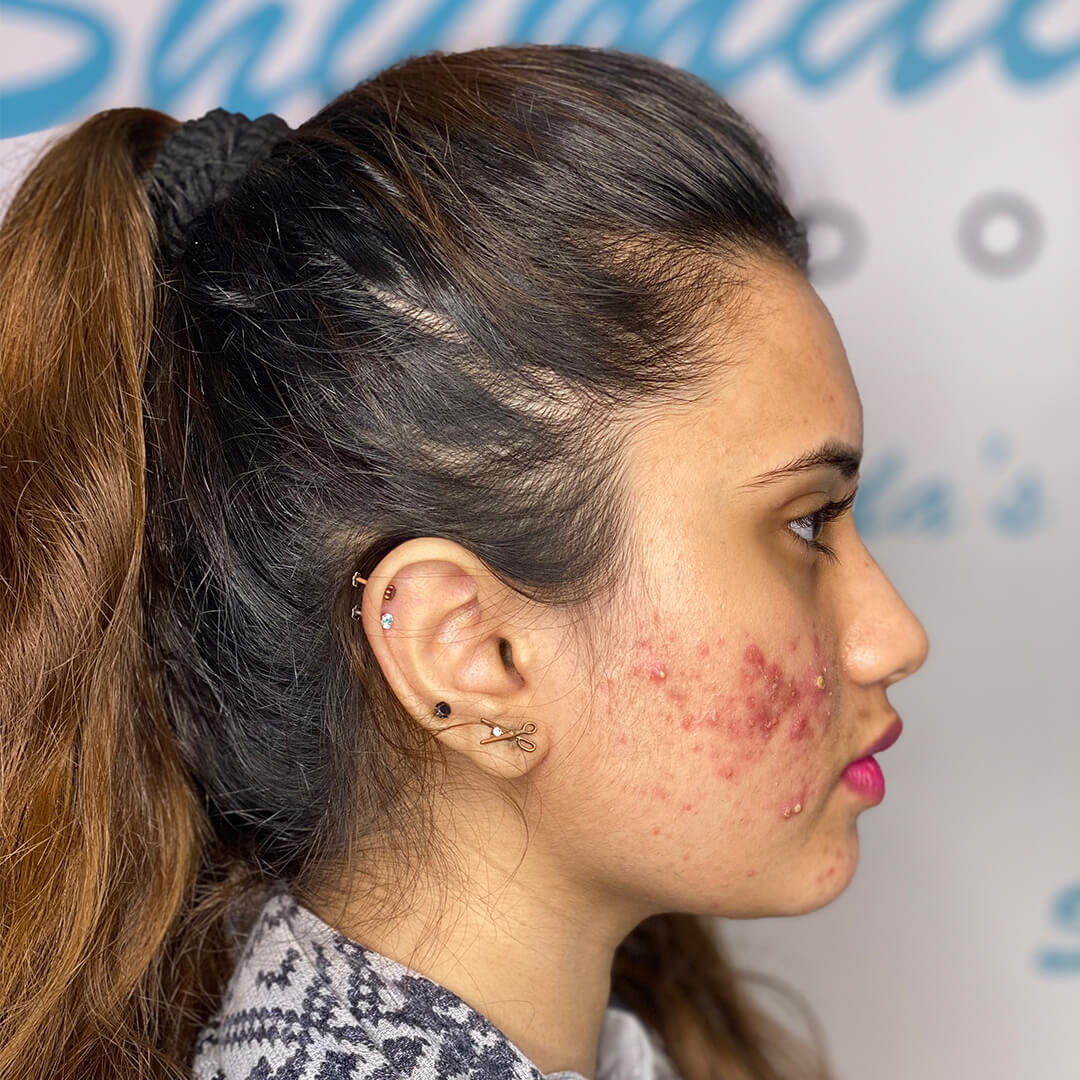 Before acne treatment london