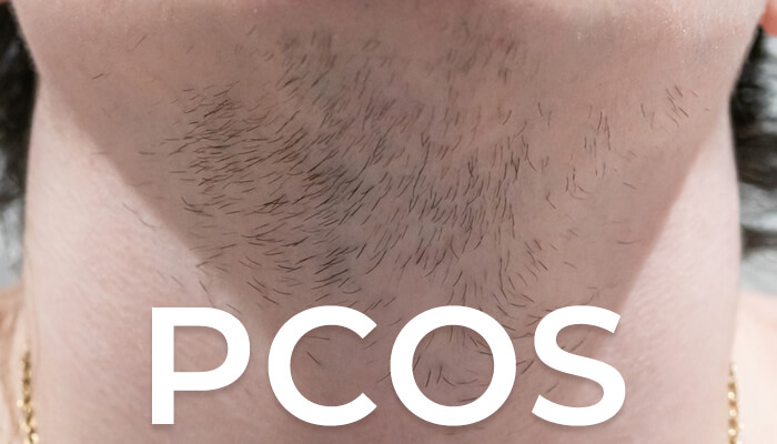 PCOS  Facial Hair Ladies Were Talking To You  Your Tea Blog