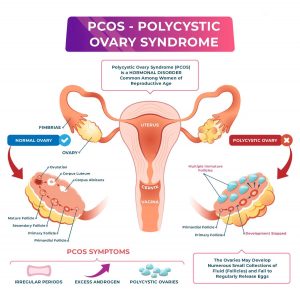 Pcos polycystic ovary syndrome