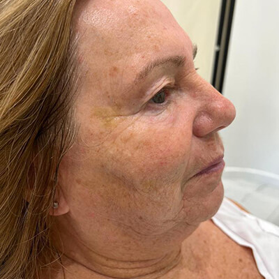 after hifu treatment