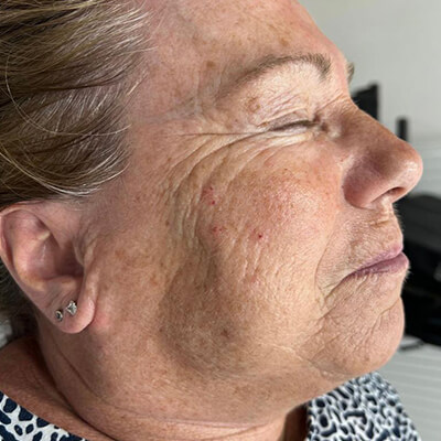 before hifu treatment london