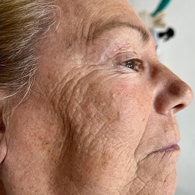before hifu treatment