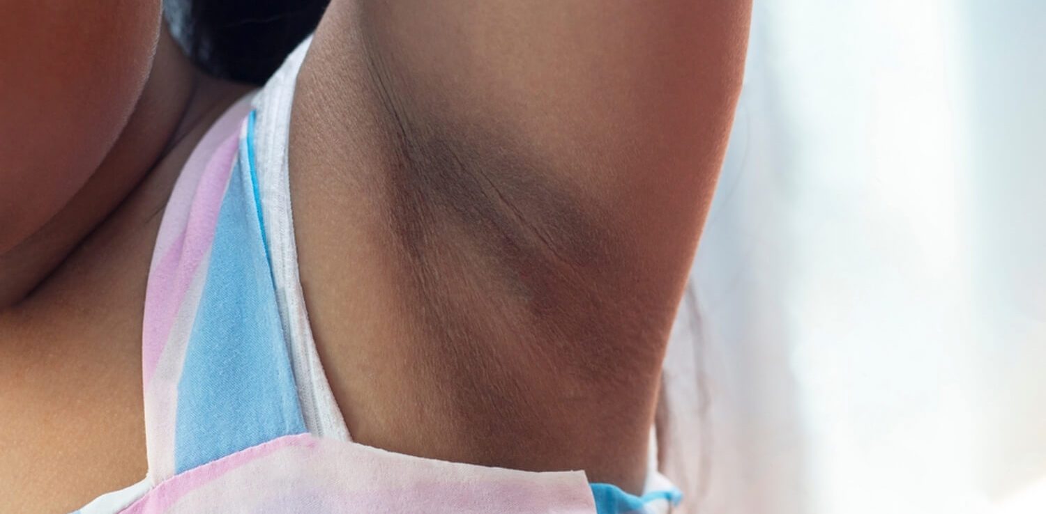 Dark and Pigmented Underarms