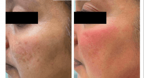 cosmelan peel in london before and after