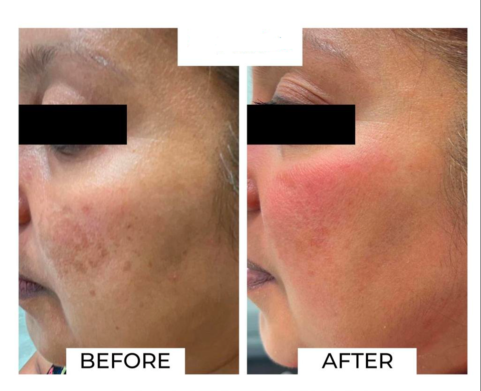 cosmelan peel in london before and after