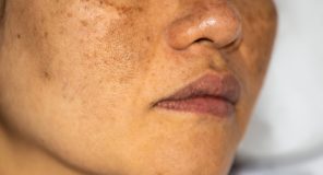 Face Pigmentation Treatment