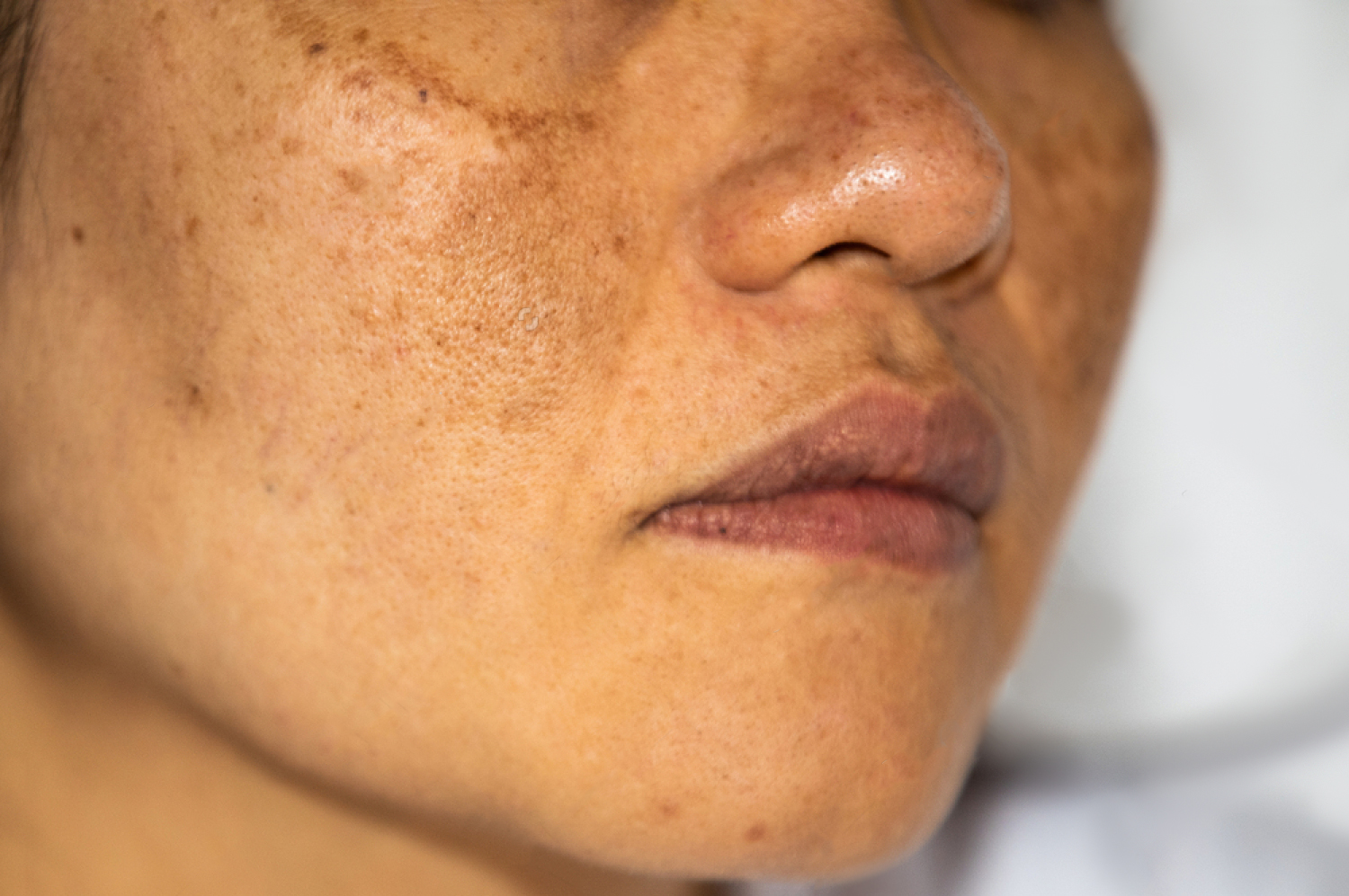 Face Pigmentation Treatment