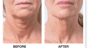 profhilo treatment done on neck of a woman in loughton