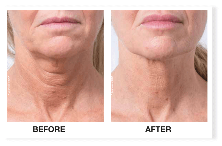 profhilo treatment done on neck of a woman in loughton