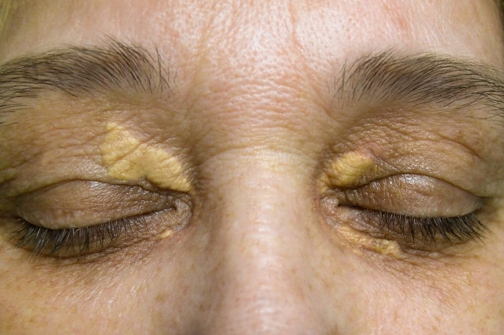 xanthelasma on top and bottom eyelid treatment in london