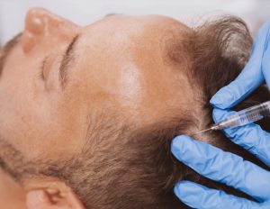 Hair Loss Treatment