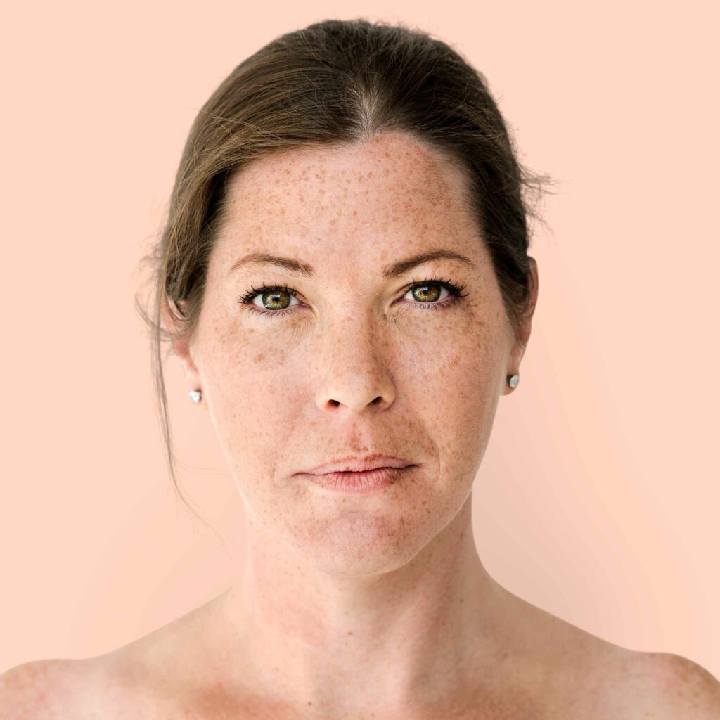 Middle-aged woman with freckles looking at the camera before freckle removal treatment